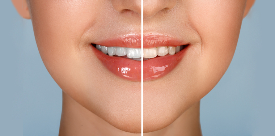 5 otázek o bělení zubů, na které chcete znát odpověď
