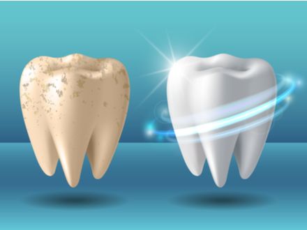 5 tipů jak zatočit se žlutými zuby - zkuste bělící pasty